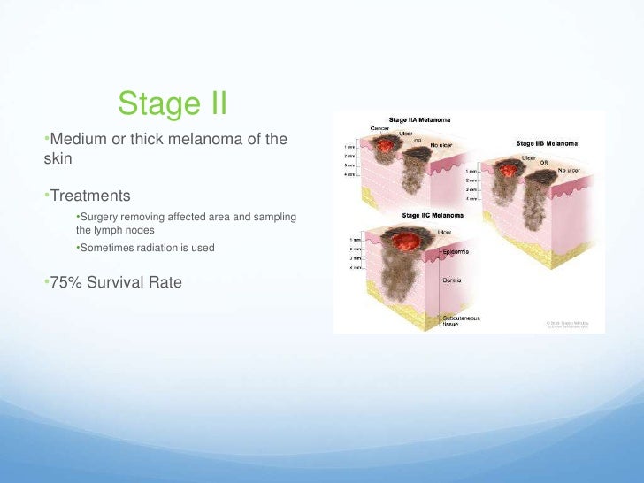 Melanoma presentation