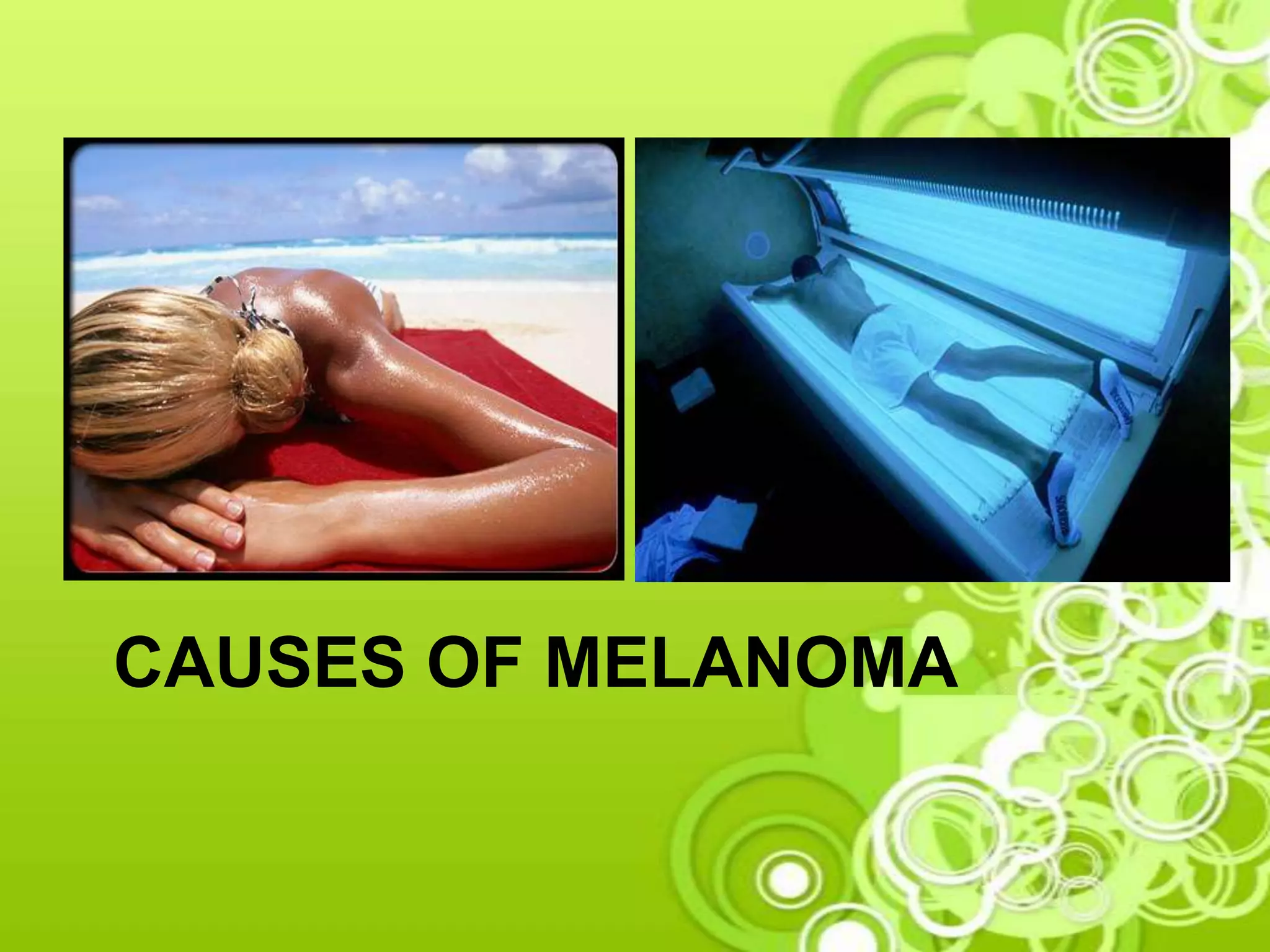 CAUSES OF MELANOMA
 