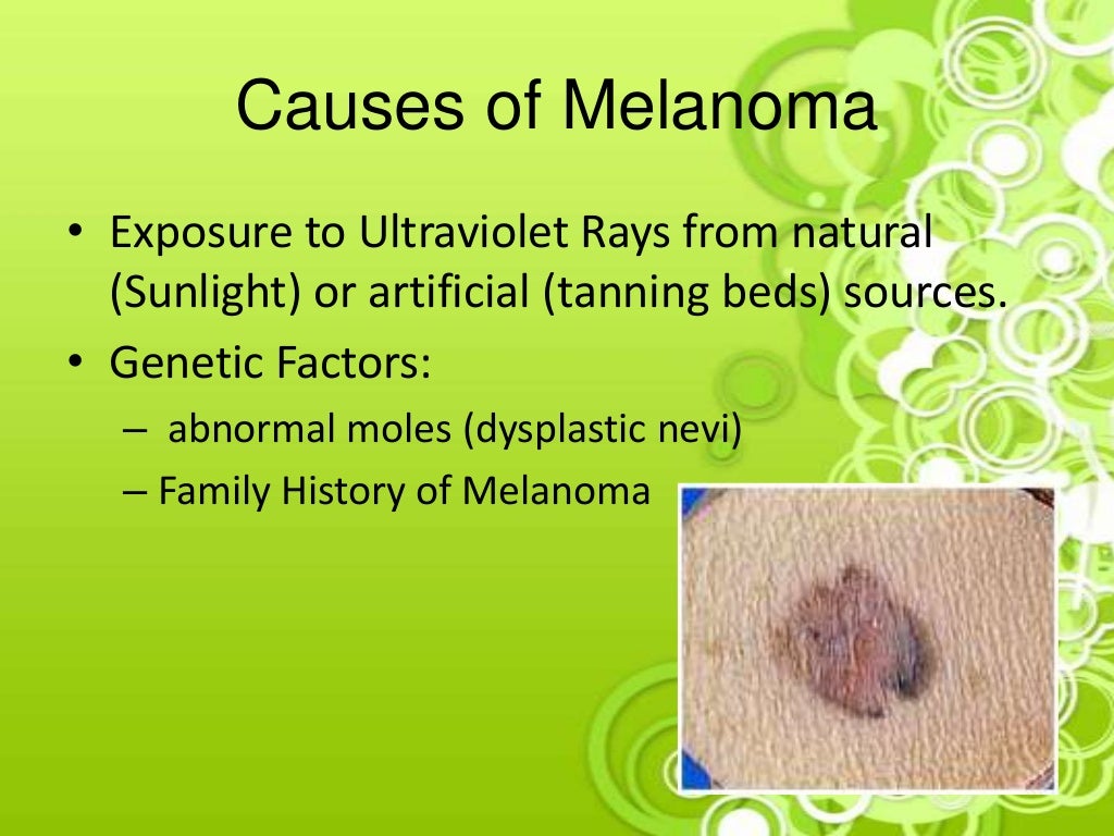 Melanoma Case Study