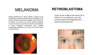 MELANOMA
Puede producirse en varios tejidos, aunque el de
localización coroidea (melanoma de coroides) es el
tumor intraocular primario maligno más común en
el adulto. Su número de casos aumenta todavía
más si se tienen en cuenta los tumores secundarios
a otros procesos cancerosos que acaban
provocando metástasis en el ojo, como el de mama
o el de pulmón.
RETINOBLASTOMA
Tumor ocular maligno más común en la
infancia. Es muy agresivo y, por ello,
resulta fundamental diagnosticarlo y
tratarlo tempranamente.
 
