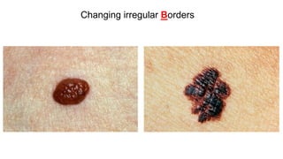 Melanoma update 2019- Dr Anand Bhandary Panambur | PDF