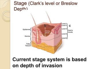 Melanoma video slides | PPTX