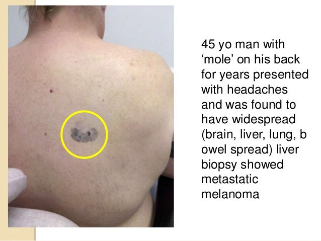 how does melanoma spread