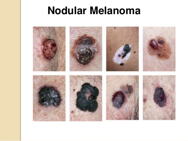 Melanoma video slides