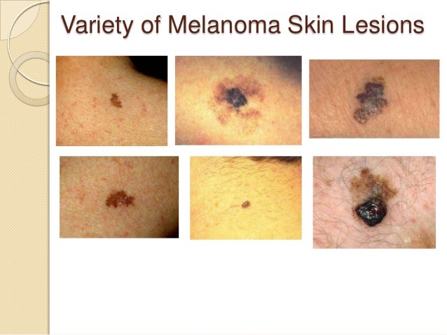 Melanoma | Primary Care Dermatology Society | UK