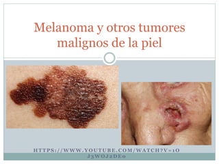 Melanoma y otros tumores 
malignos de la piel 
HTTPS: / /WWW.YOUTUBE.COM/WATCH?V=1O 
J3WOJ2DE0 
 