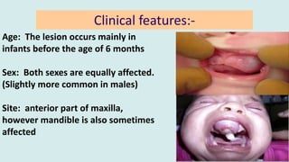 Melanotic Neuroectodermal tumor of infancy