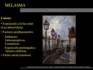 MELASMACausas: Exposición a la luz solar (Luz ultravioleta).