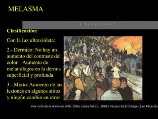 Respeta los párpadosMELASMAMorfología:Manchas de color café variando en tamaño e intensidad desde un tono clara a otro muy obscuro.Generalmente no tienen una tonalidad uniforme.