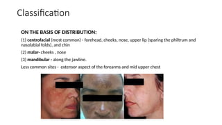 Classification
ON THE BASIS OF DISTRIBUTION:
(1) centrofacial (most common) - forehead, cheeks, nose, upper lip (sparing the philtrum and
nasolabial folds), and chin
(2) malar- cheeks , nose
(3) mandibular - along the jawline.
Less common sites - extensor aspect of the forearms and mid upper chest
 