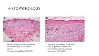 HISTOPATHOLOGY
Melanin deposition in the epidermis
and solar elastosis in the dermis
(arrow)
(Hematoxylin and Eosin, HEx100)
Pendulous melanocytes in the basal
layer of epidermis (arrow) and
increased dermal melanophages
(arrowhead) (HE x400).
 