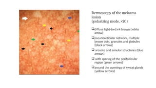 Dermoscopy of the melasma
lesion
(polarizing mode, ×20)
diffuse light-to-dark brown (white
arrow)
pseudoreticular network, multiple
brown dots, granules and globules
(black arrows)
 arcuate and annular structures (blue
arrows)
 with sparing of the perifollicular
region (green arrows)
around the openings of sweat glands
(yellow arrows)
 