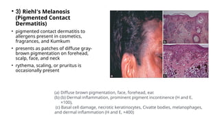 • 3) Riehl′s Melanosis
(Pigmented Contact
Dermatitis)
• pigmented contact dermatitis to
allergens present in cosmetics,
fragrances, and Kumkum
• presents as patches of diffuse gray-
brown pigmentation on forehead,
scalp, face, and neck
• rythema, scaling, or pruritus is
occasionally present
(a) Diffuse brown pigmentation, face, forehead, ear.
(b) (b) Dermal inflammation, prominent pigment incontinence (H and E,
×100),
(c) Basal cell damage, necrotic keratinocytes, Civatte bodies, melanophages,
and dermal inflammation (H and E, ×400)
 