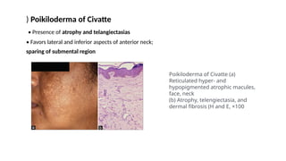 ) Poikiloderma of Civatte
• Presence of atrophy and telangiectasias
• Favors lateral and inferior aspects of anterior neck;
sparing of submental region
Poikiloderma of Civatte (a)
Reticulated hyper- and
hypopigmented atrophic macules,
face, neck
(b) Atrophy, telengiectasia, and
dermal fibrosis (H and E, ×100
 