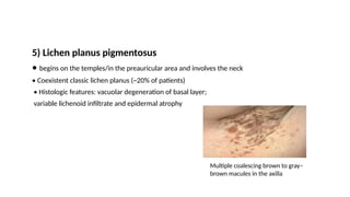 5) Lichen planus pigmentosus
• begins on the temples/in the preauricular area and involves the neck
• Coexistent classic lichen planus (~20% of patients)
• Histologic features: vacuolar degeneration of basal layer;
variable lichenoid infiltrate and epidermal atrophy
Multiple coalescing brown to gray–
brown macules in the axilla
 