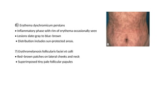6) Erythema dyschromicum perstans
• Inflammatory phase with rim of erythema occasionally seen
• Lesions slate-gray to blue–brown
• Distribution includes sun-protected areas.
7) Erythromelanosis follicularis faciei et colli
• Red–brown patches on lateral cheeks and neck
• Superimposed tiny pale follicular papules
 