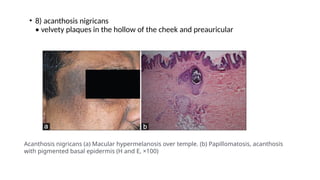 • 8) acanthosis nigricans
• velvety plaques in the hollow of the cheek and preauricular
Acanthosis nigricans (a) Macular hypermelanosis over temple. (b) Papillomatosis, acanthosis
with pigmented basal epidermis (H and E, ×100)
 