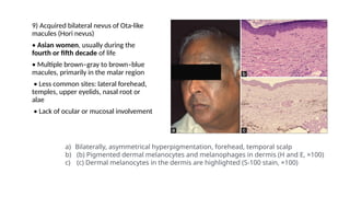 9) Acquired bilateral nevus of Ota-like
macules (Hori nevus)
• Asian women, usually during the
fourth or fifth decade of life
• Multiple brown–gray to brown–blue
macules, primarily in the malar region
• Less common sites: lateral forehead,
temples, upper eyelids, nasal root or
alae
• Lack of ocular or mucosal involvement
a) Bilaterally, asymmetrical hyperpigmentation, forehead, temporal scalp
b) (b) Pigmented dermal melanocytes and melanophages in dermis (H and E, ×100)
c) (c) Dermal melanocytes in the dermis are highlighted (S-100 stain, ×100)
 