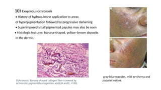 10) Exogenous ochronosis
• History of hydroquinone application to areas
of hyperpigmentation followed by progressive darkening
• Superimposed small pigmented papules may also be seen
• Histologic features: banana-shaped, yellow–brown deposits
in the dermis
gray-blue macules, mild erythema and
papular lesions.
Ochronosis: Banana-shaped collagen fibers covered by
ochronotic pigment (homogentisic acid) (H and E, ×100)
 