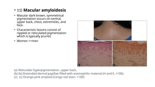 • 11) Macular amyloidosis
• Macular dark brown, symmetrical
pigmentation occurs on central,
upper back, chest, extremities, and
face.
• Characteristic lesions consist of
rippled or reticulated pigmentation
which is typically pruritic
• Women >>men
(a) Reticulate hyperpigmentation, upper back,
(b) (b) Distended dermal papillae filled with eosinophilic material (H and E, ×100),
(c) (c) Orange-pink amyloid (Congo red stain, ×100)
 