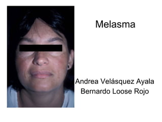 Melasma Andrea Velásquez Ayala Bernardo Loose Rojo 