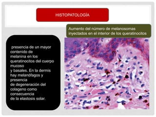 HISTOPATOLOGÍA
presencia de un mayor
contenido de
melanina en los
queratinocitos del cuerpo
mucoso
y basales. En la dermis
hay melanófagos y
presencia
de degeneración del
colageno como
consecuencia
de la elastosis solar.
Aumento del número de melanosomas
inyectados en el interior de los queratinocitos
 