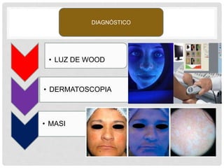 • LUZ DE WOOD
• DERMATOSCOPIA
• MASI
DIAGNÓSTICO
 