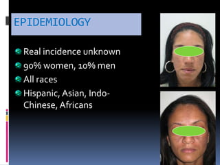 EPIDEMIOLOGY

 Real incidence unknown
 90% women, 10% men
 All races
 Hispanic, Asian, Indo-
 Chinese, Africans
 