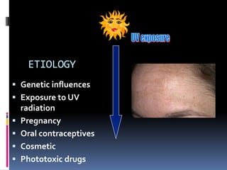 ETIOLOGY
 Genetic influences
 Exposure to UV
  radiation
 Pregnancy
 Oral contraceptives
 Cosmetic
 Phototoxic drugs
 