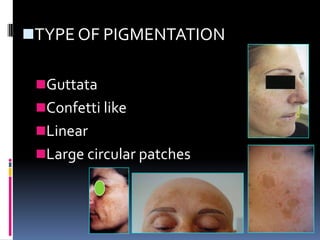 TYPE OF PIGMENTATION

 Guttata
 Confetti like
 Linear
 Large circular patches
 