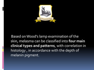Based on Wood’s lamp examination of the
skin, melasma can be classified into four main
clinical types and patterns, with correlation in
histology , in accordance with the depth of
melanin pigment.
 