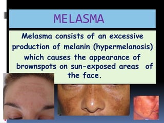 MELASMA
  Melasma consists of an excessive
production of melanin (hypermelanosis)
   which causes the appearance of
 brownspots on sun-exposed areas of
               the face.
 
