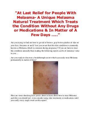 "At Last Relief for People With
Melasma- A Unique Melasma
Natural Treatment Which Treats
the Condition Without Any Drugs
or Medications & In Matter of A
Few Days …..”
Are you trying to find out how to get rid of brown- gray brown patches of skin on
your face, forearms or neck? Are you aware that this skin condition is commonly
known as Melasma which is common during pregnancy? If you are keen to treat
this condition naturally then reading the following report can be of immense value
to you …
Are you ready to discover a breakthrough secret which can easily treat Melasma
permanently in matter of days?
Here are some shocking facts you're about to learn about how to treat Melasma
and why you should not even consider using skin treatments or medication, until
you ready every single word on this report!
 