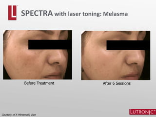 SPECTRA with laser toning: Melasma
Courtesy of A Miresmaili, Iran
Before Treatment After 6 Sessions
 