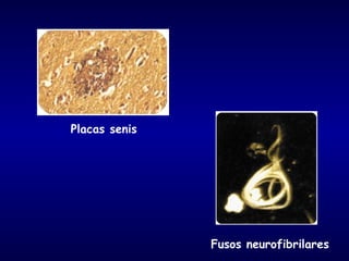 Placas senis
Fusos neurofibrilares
 