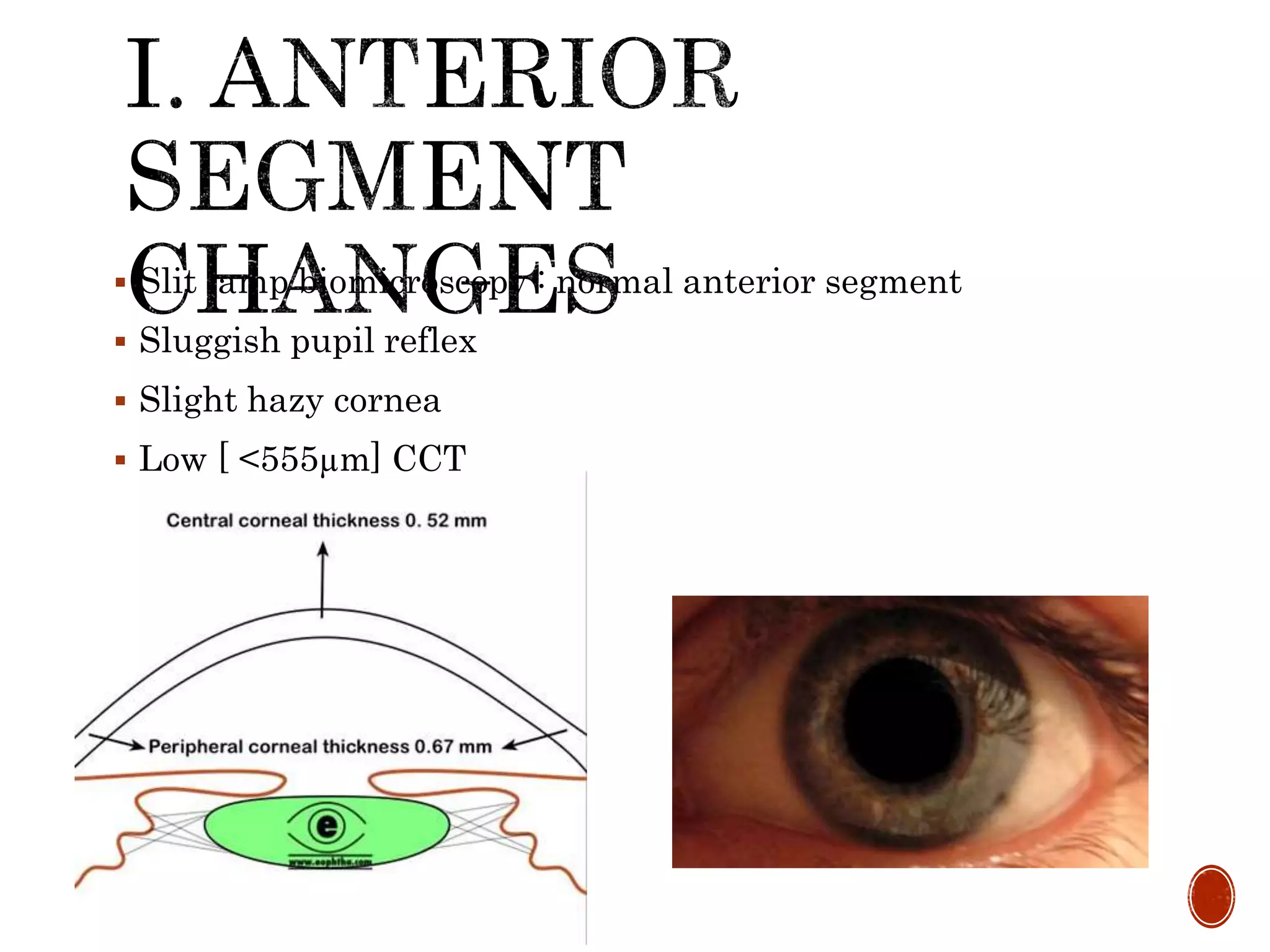  Slit lamp biomicroscopy : normal anterior segment
 Sluggish pupil reflex
 Slight hazy cornea
 Low [ <555µm] CCT
 