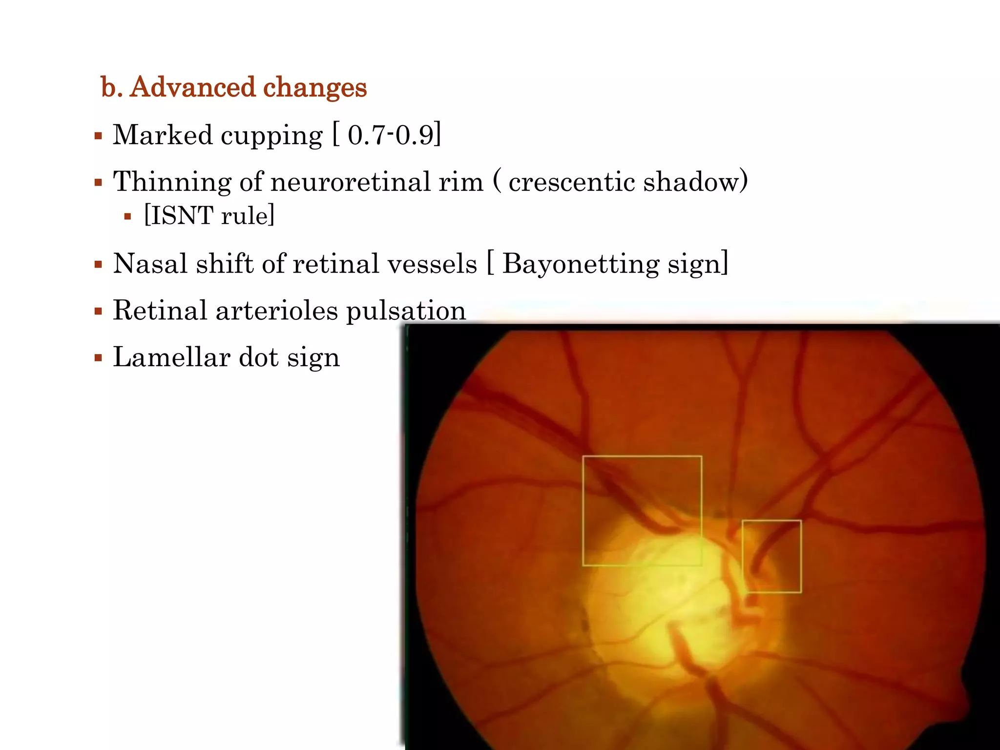 b. Advanced changes
 Marked cupping [ 0.7-0.9]
 Thinning of neuroretinal rim ( crescentic shadow)
 [ISNT rule]
 Nasal shift of retinal vessels [ Bayonetting sign]
 Retinal arterioles pulsation
 Lamellar dot sign
 