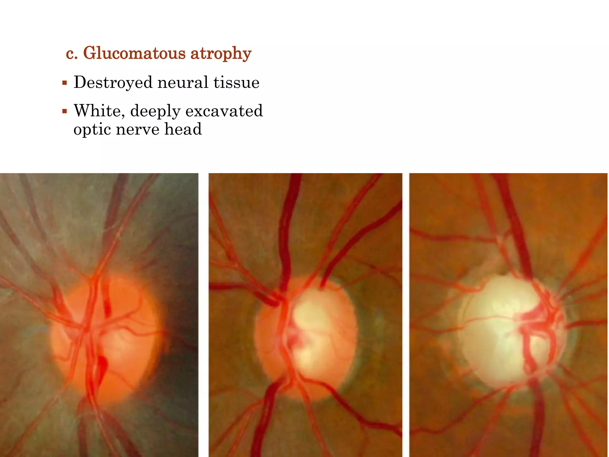 c. Glucomatous atrophy
 Destroyed neural tissue
 White, deeply excavated
optic nerve head
 