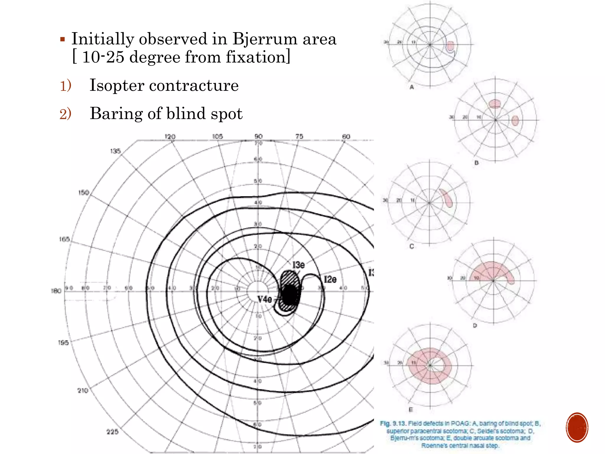  Initially observed in Bjerrum area
[ 10-25 degree from fixation]
1) Isopter contracture
2) Baring of blind spot
3) Small wing- shaped paracentral
scotoma
4) Seidel’s scotoma
5) Bjerrum’s scotoma /Arcuate
6) Ring/ Double arcuate scotoma
7) Roenne’s central nasal step
8) Peripheral field defects
9) Advanced glaucomatous field
defects [ tubular vision,
temporal island]
 