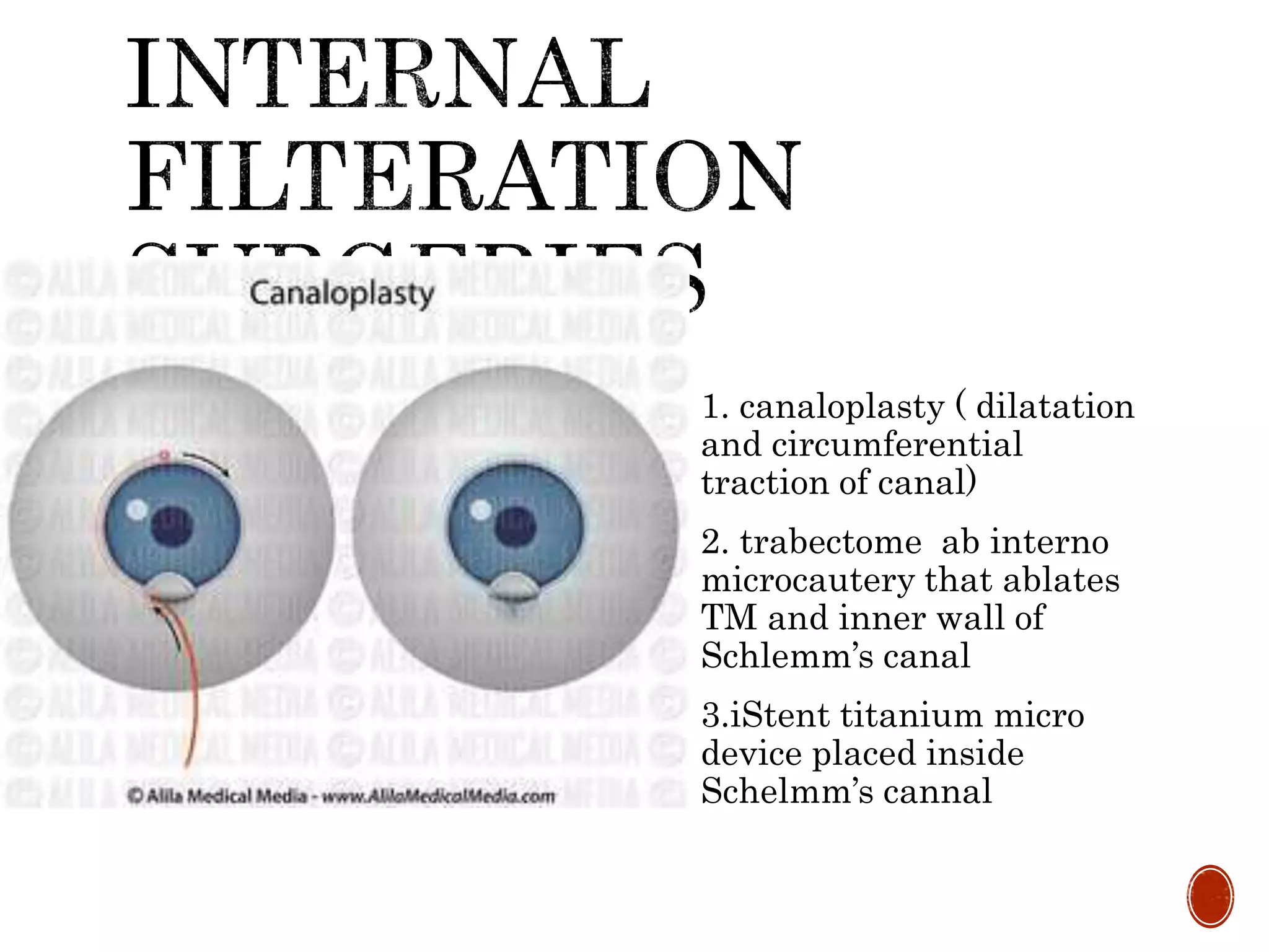  Restore filteration through
Schlemm’s canal
 To keep normal anatomy
and conjunctival bleb
free reducing risk of
endophthalmitis and
ocular hypotomy
 1. canaloplasty ( dilatation
and circumferential
traction of canal)
 2. trabectome ab interno
microcautery that ablates
TM and inner wall of
Schlemm’s canal
 3.iStent titanium micro
device placed inside
Schelmm’s cannal
 