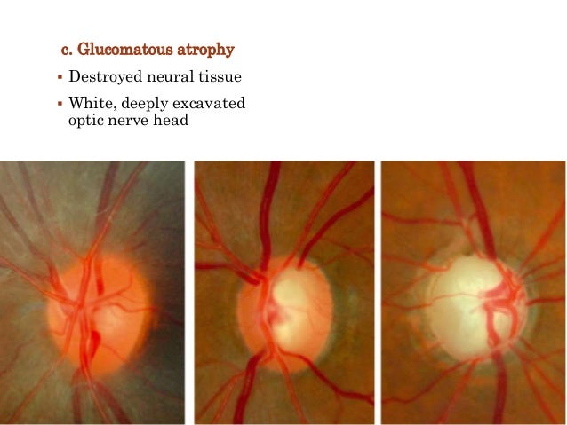Open angle glaucoma age picture