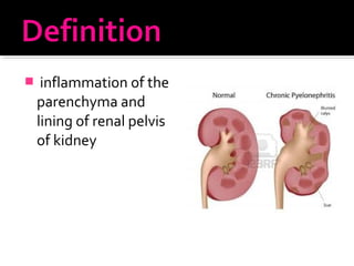  inflammation of the
parenchyma and
lining of renal pelvis
of kidney
 
