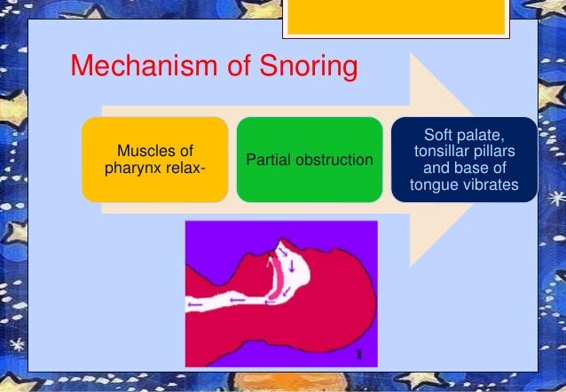 Snoring Mechanism | The Diagnosis and Treatment of Snoring in Adults – DOUT