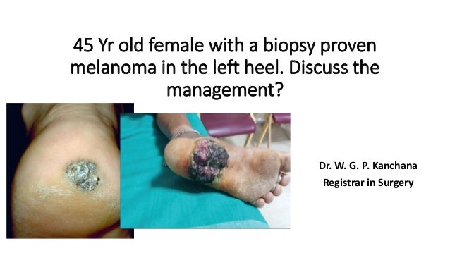 management of malignant melanoma