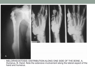 • MELORHEOSTOSIS: DISTRIBUTION ALONG ONE SIDE OF THE BONE. A.
Humerus. B. Hand. Note the extensive involvement along the lateral aspect of the
hand and humerus.
 