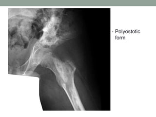 • Polyostotic
form
 