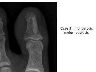 Case 3 : monostotic
melorheostosis

 