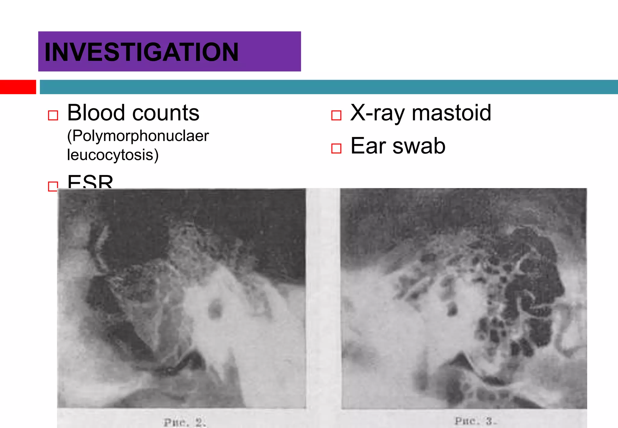  Blood counts
(Polymorphonuclaer
leucocytosis)
 ESR
 X-ray mastoid
 Ear swab
INVESTIGATION
 