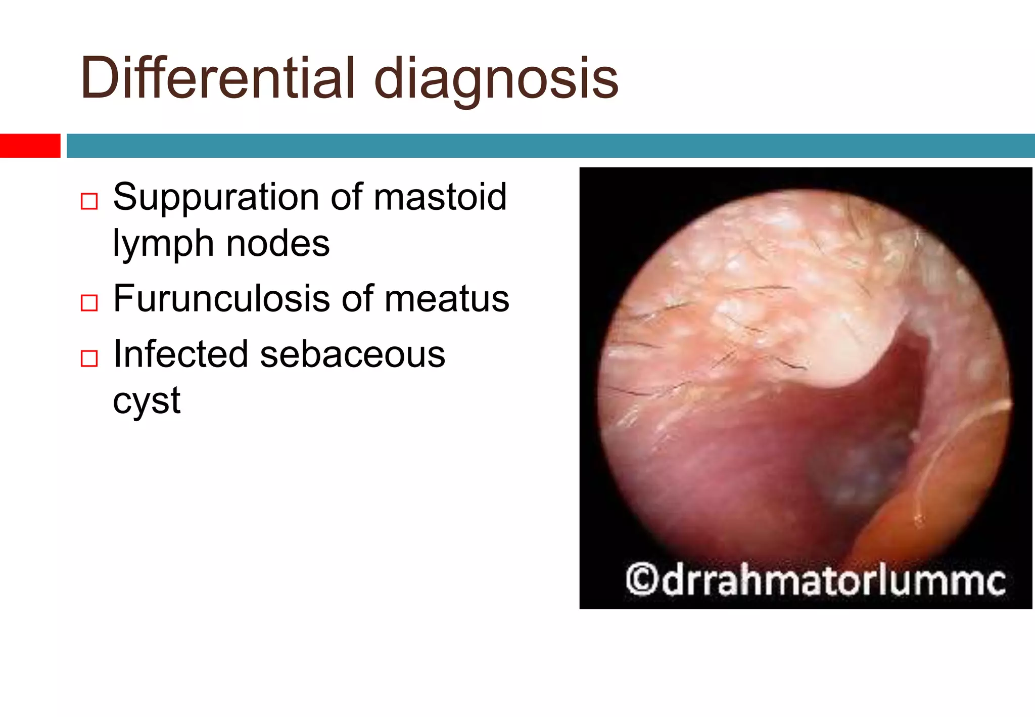 Differential diagnosis
 Suppuration of mastoid
lymph nodes
 Furunculosis of meatus
 Infected sebaceous
cyst
 