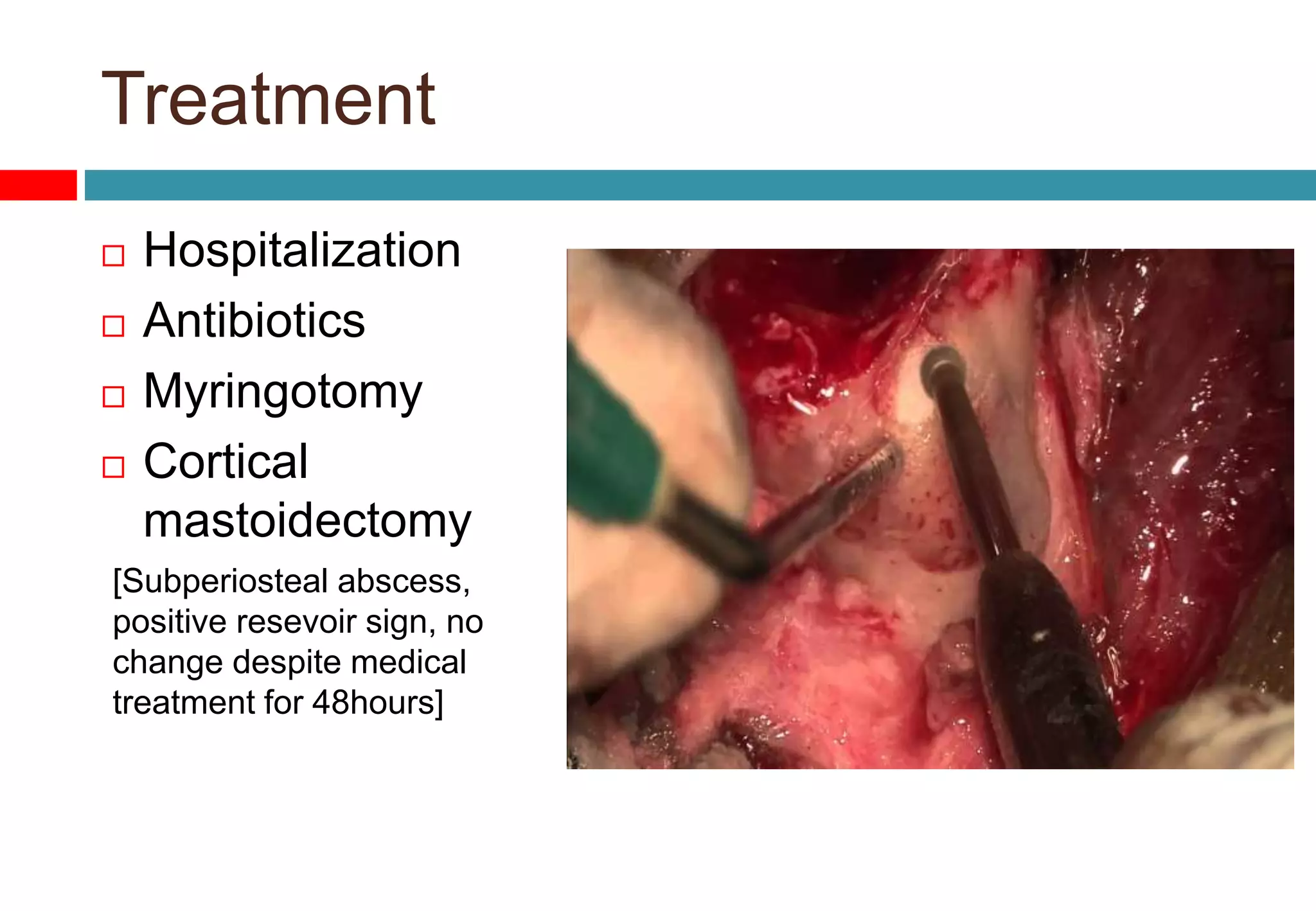 Treatment
 Hospitalization
 Antibiotics
 Myringotomy
 Cortical
mastoidectomy
[Subperiosteal abscess,
positive resevoir sign, no
change despite medical
treatment for 48hours]
 